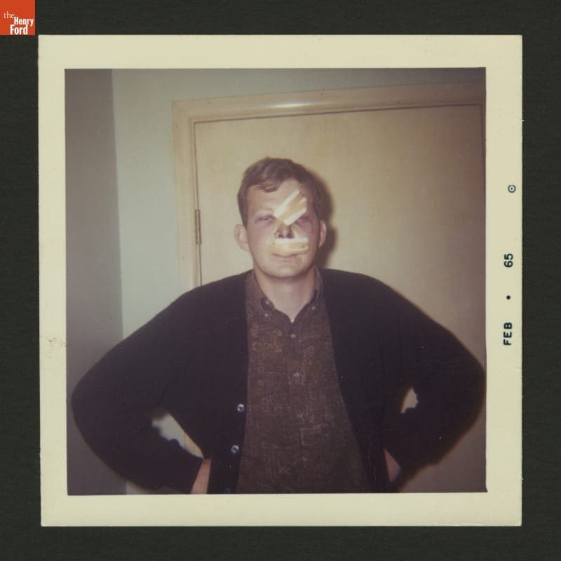 Man with Injuries Sustained in an Automobile Accident, 1965